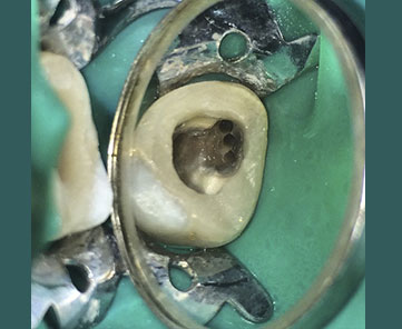 tratamiento de endodoncia quito