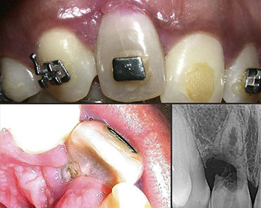 casos de endondoncia Dr. Raul aponte