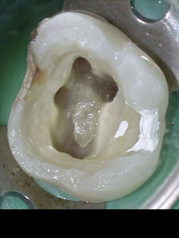 Endodoncia microscopica