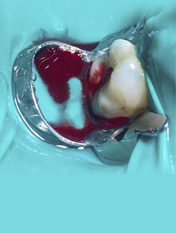 prevencion y diagnostico de patologia pulpares y perirradiculares