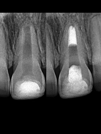 tratamiento de conducto de dientes